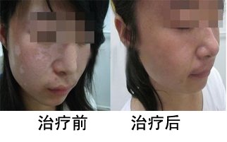 女性泛发型白癜风怎么治疗好(图1)