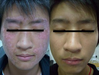白癜风复发有何症状体现呢?(图1) 白癜风复发有何症状体现呢