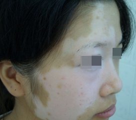 白癜风治疗艰难的原因是什么