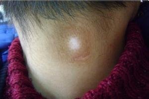 白癜风患者护理怎么做?(图1)