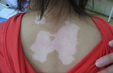 白癜风症状