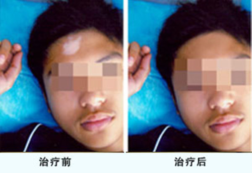 马春林专家讲解：白癜风患者要注意哪些事项呢(图1)