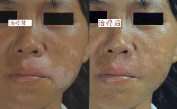 白癜风都会用什么方法治疗?(图1)