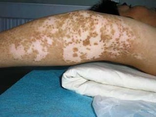 白癜风的初发症状有哪些?(图1)