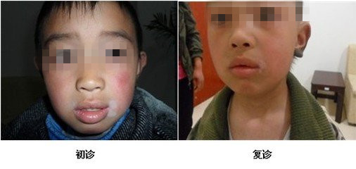 儿童白癜风的治疗效果会受什么因素影响?(图1)