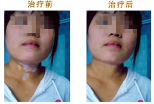 女性患上白癜风需要注意哪些方面?(图1)