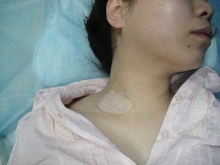 女性患上白癜风的症状有什么?(图1)