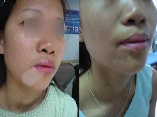 需要花多少钱才能治好白癜风?(图1)