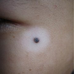 生活中男性白癜风患者应该注意什么?(图1)