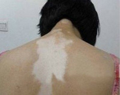 青少年如何预防白癜风呢?(图1)