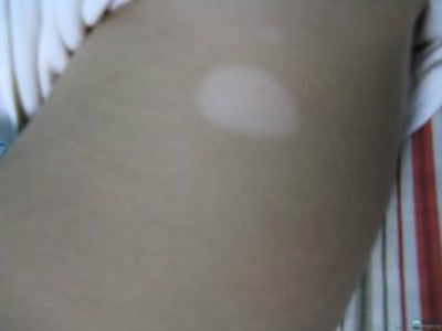白癜风的原因究竟有哪些?(图1) 白癜风的原因究竟有哪些?(图1)