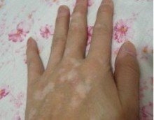冬季冻伤会导致白癜风加重吗?(图1)