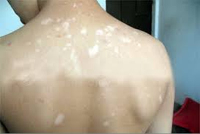 那么白癜风根据什么进行诊断(图1)