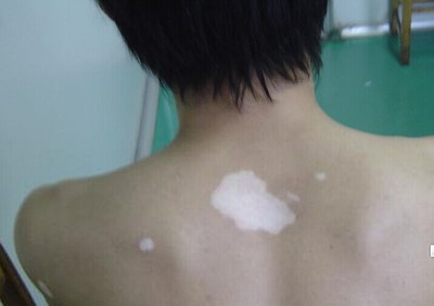 为什么化妆品会导致白癜风的发生(图1)
