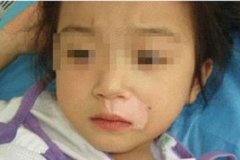 小儿面部的白癜风应该如何进行治疗(图1)