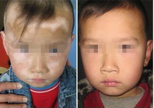 颈部白癜风的病因有哪些(图1) 颈部白癜风的病因有哪些(图1)