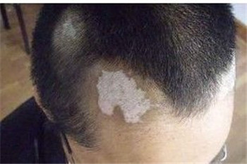 白癜风如何控制?(图1)