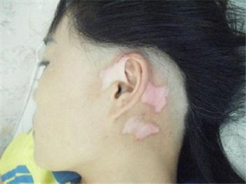 对于女性白癜风患者要注意什么