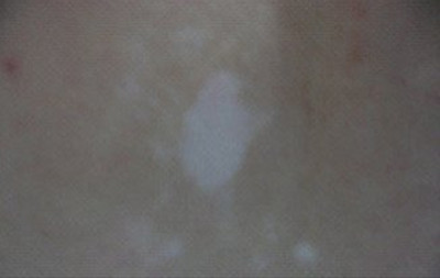 护理男性白癜风要怎么做